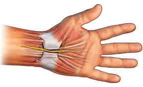 síndrome del túnel carpiano.jpeg